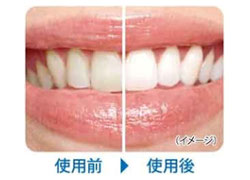 わずかな期間で、自然な白い歯へ
