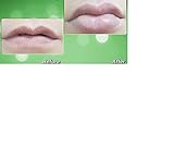 ソフト・マウスクッション CandyLipz Model A Double Lobed Lip Plumper - Lip Plumping tool - Easy to use!