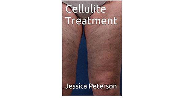 cellulite treatment