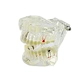 Zorvo Dental Implant Disease Teeth Model with Restoration & Bridge Tooth Transparent Dental Implant 