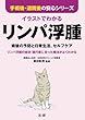 イラストでわかる　リンパ浮腫