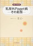 カラーアトラス乳房外Paget病－その素顔－