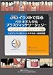 3Dイラストで見るペリオドンタルプラスティックサージェリー インプラント・ポンティック編
