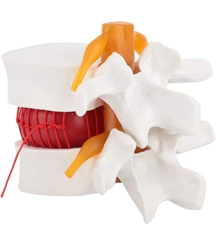 Lumbar Vertebrae Degeneration Model At ₹ 3650/piece | Dadri | ID: 2851551908730 - View #8