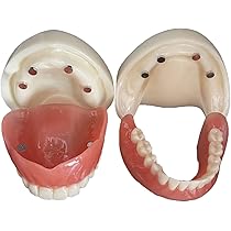 ○歯科用　部分床義歯ノンメタルクラスプ義歯デモ用模型 FEEDデンタル】リアルモデルE 金属床義歯 フルタイプの通販