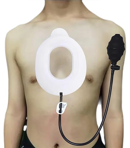 バキュームベル　漏斗胸 Amazon.co.jp: 漏斗胸バキュームベル - 漏斗胸装具ブレース、漏斗胸の