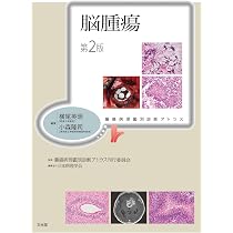 脳腫瘍 第2版(腫瘍病理鑑別診断アトラス) | 横尾 英明, 小森 隆司 |本 アトラス脳腫瘍病理裁断済み