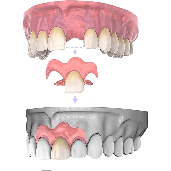 Make the Dental mamelon! こだわりの前歯部精密修復 Make the Dental mamelon! こだわりの前歯部精密修復｜歯科学全般