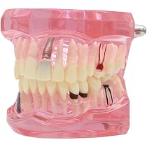 Dental Teaching Model - Single Piece Implant & Bridge Demonstration Tooth With Brackets