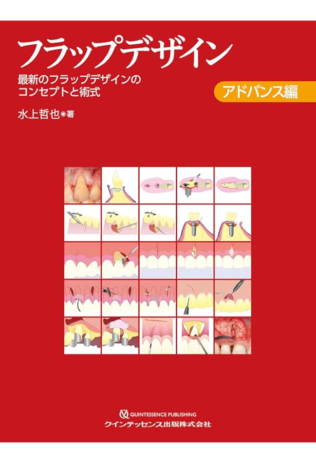 フラップデザイン ベーシック編: 4つの要素でわかる再生療法の